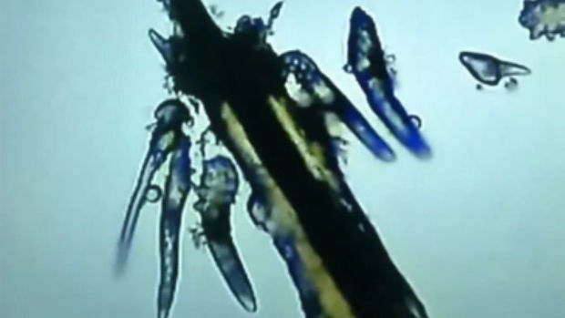 Çinli qadın kipriklərində minlərlə gənə yetişdirdi