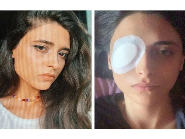 Bakıda lazer epilyasiyasında qızın gözünü zədələdilər – Kor olacaqdı – FOTO