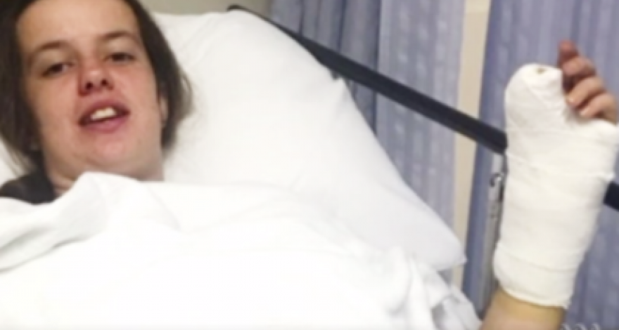 Девушке пришили палец ноги вместо большого пальца руки