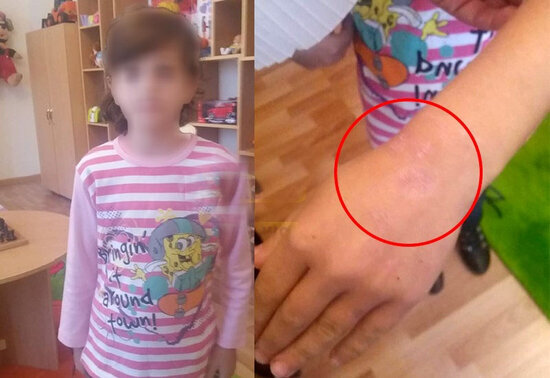 Azərbaycanda ana övladının əlinə siqaret kötüyü basdı, uşaq evdən qaçdı - FOTO