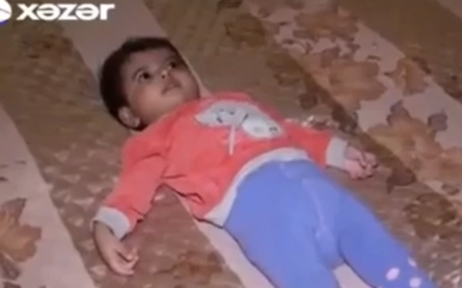 Peyvənddən sonra uşaq bu hala düşdü - VİDEO