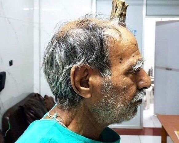 Kişi 10 santimetrlik buynuz çıxardı - FOTO