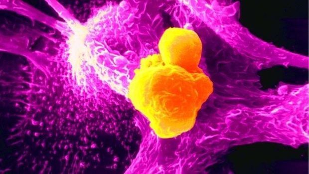 Xərçəngin müalicəsində inqilabi - YENİLİK