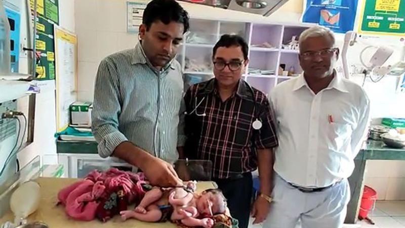 Dörd ayaqlı, üç əlli körpə doğuldu