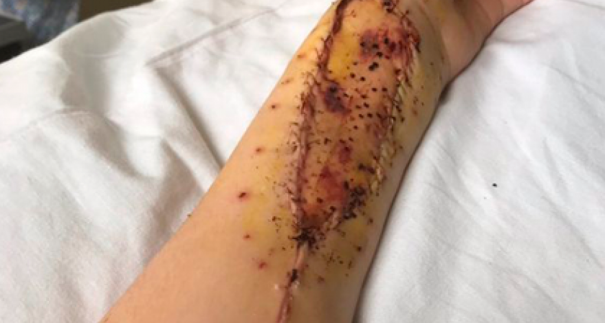 Женщине сделали язык из ее собственной руки