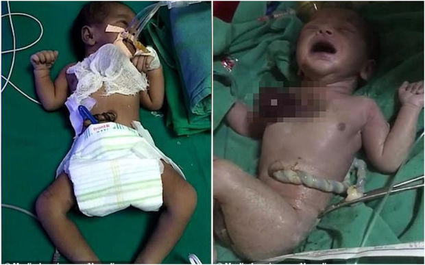 Ürəyi bədənin xaricində olan uşaq doğulub - VİDEO