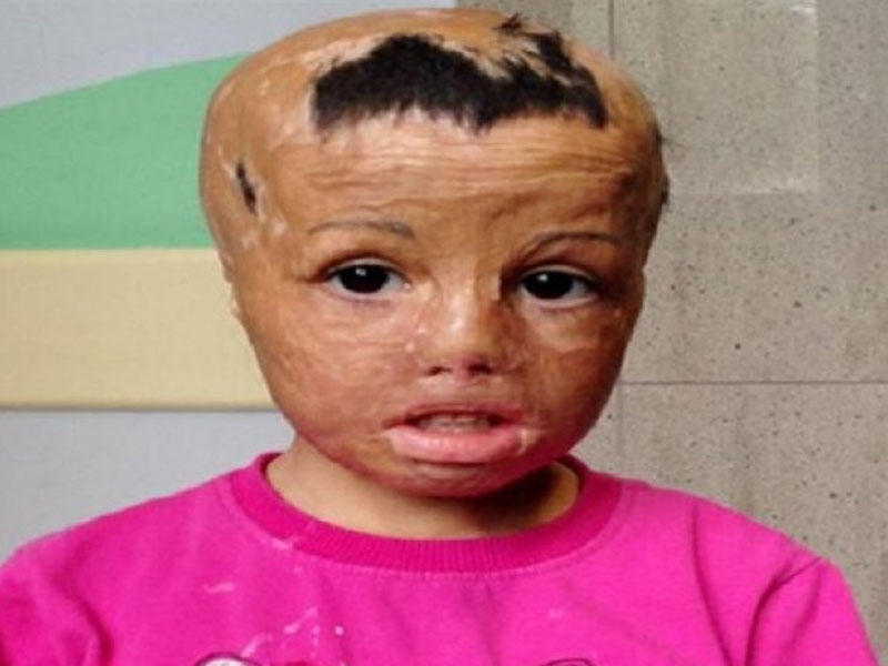 Üzü yanan qıza öz toxumasından yeni üz köçürələcək - FOTO