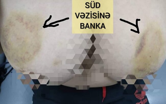 Azərbaycanda qadın süd vəzilərinə banka qoydu – Dəhşətli nəticə + FOTOLAR