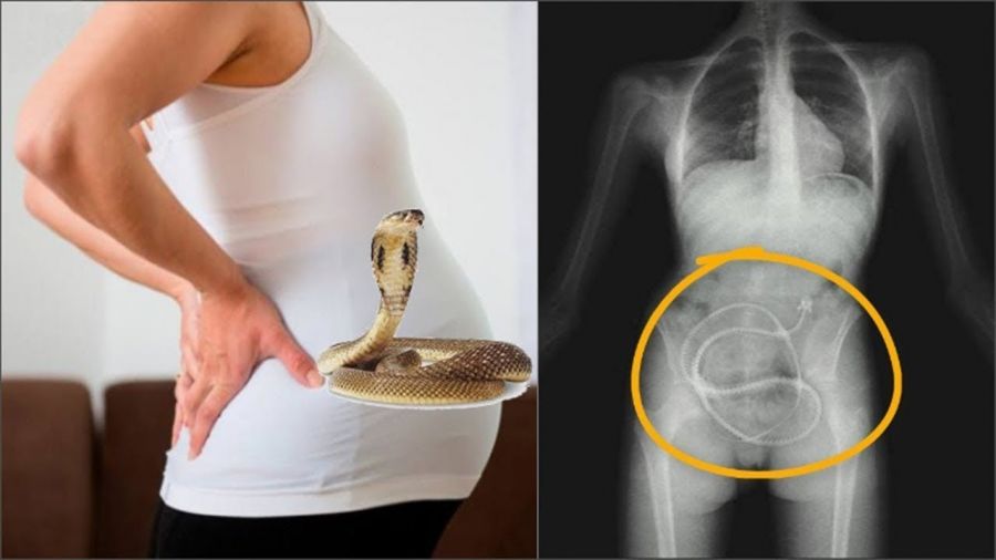 Həkimlər şokda: Hamilə qadının bətnindən uşaq əvəzinə ilan çıxdı - VİDEO