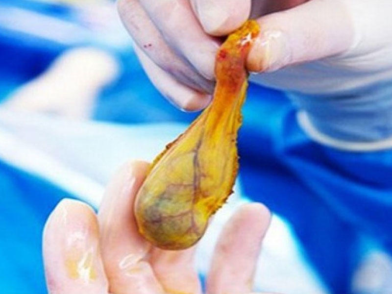 Öd kisəsi çıxarıldıqdan sonrakı həyat - Əməl olunmalı 3 qayda