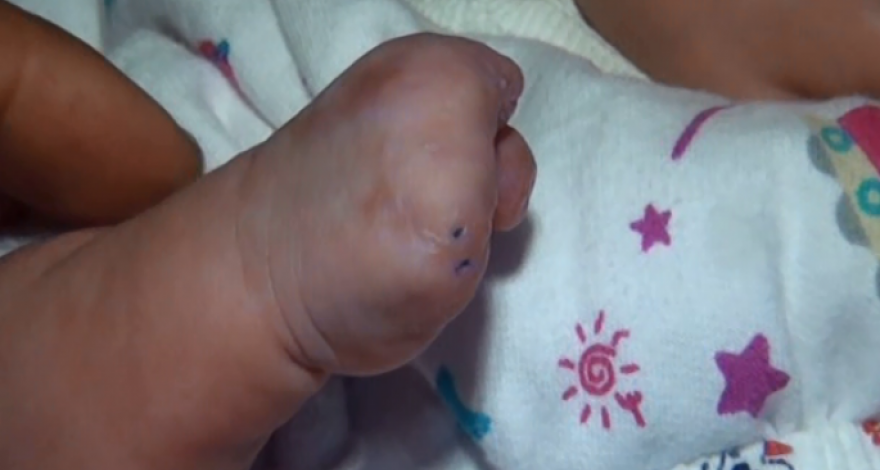 В Азербайджане трехмесячному ребенку ампутировали пальцы руки - ВИДЕО