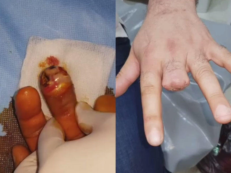 Zibil qutusundakı küçə iti barmağını dişlədi, barmağı kəsildi - VİDEO