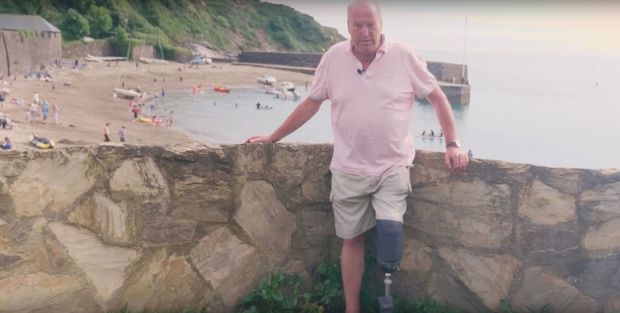 Пенсионер натер ногу сандалиями, не подозревая, что ее придется ампутировать - ФОТО