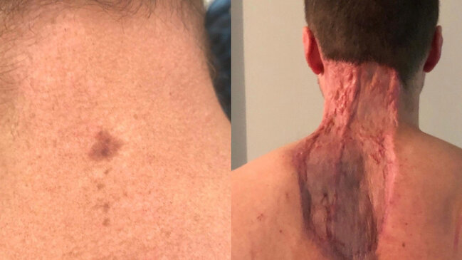 Balaca xal qorxunc xəstəliyin əlaməti imiş - FOTO