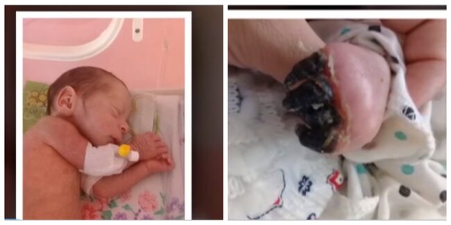 Azərbaycanda 3 aylıq körpənin barmaqları həkim səhvinə qurban getdi - FOTOLAR
