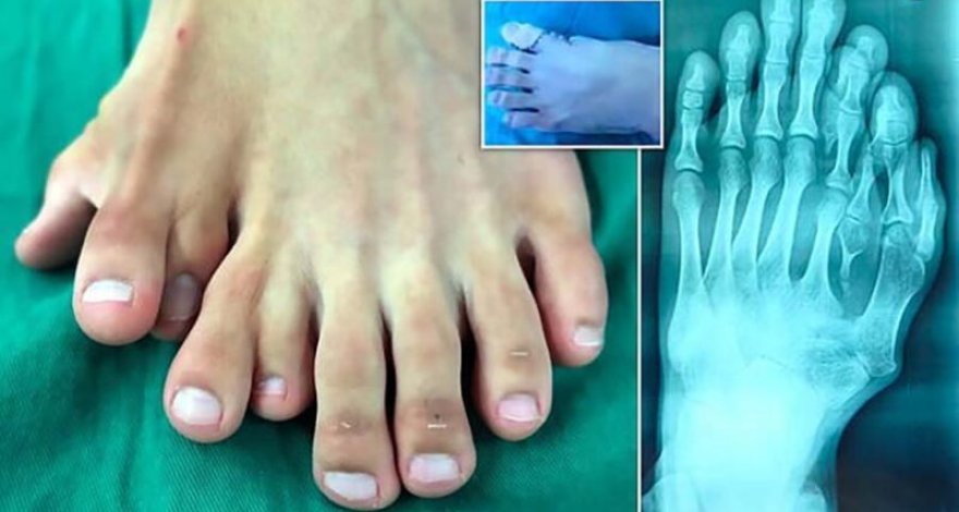 Юноша десятки лет ходил с девятью пальцами на ноге из-за суеверных родителей