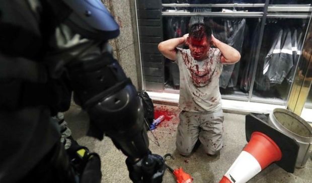 В Гонконге мужчина пожертвовал ухом ради политики - ВИДЕО