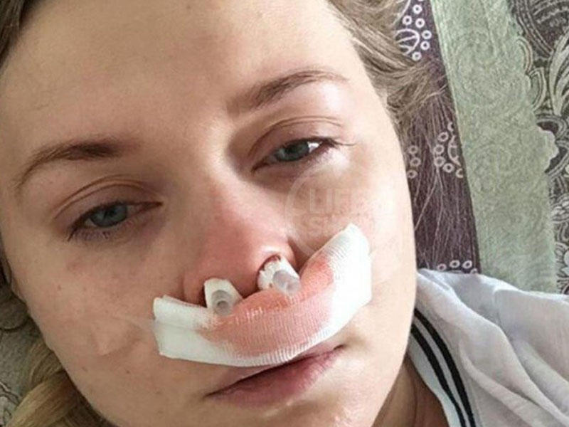 Həkim xəstənin burnunda kateteri unutdu - 10 il sonra bütün üz sümükləri irinlədi