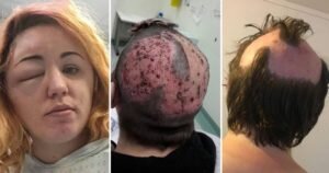 Saç boyaları TƏHLÜKƏLİDİR - BAŞ DƏRİSİ SOYULA BİLƏR - FOTOLAR