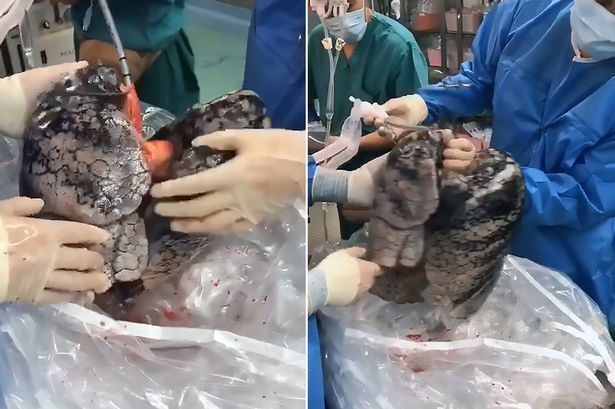 Появилось пугающее видео легких мертвого курильщика - ВИДЕО