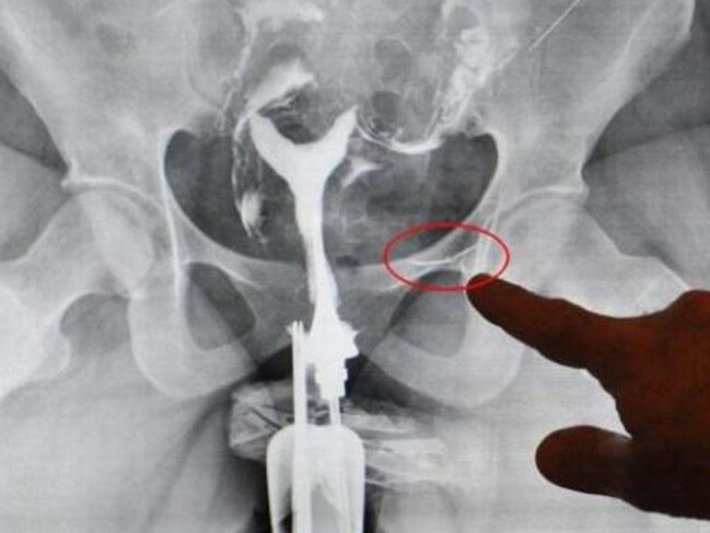 Uşağı olmayan azərbaycanlı qadın rentgenə baxanda ŞOK OLDU - 16 il əvvəl...