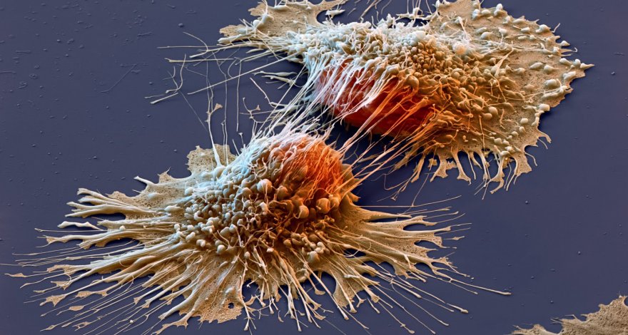 Ученые разобрались, что происходит в клеточных ядрах при развитии рака