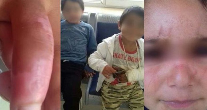 Госкомитет начал разбирательство по факту избиения в Баку детей мачехой