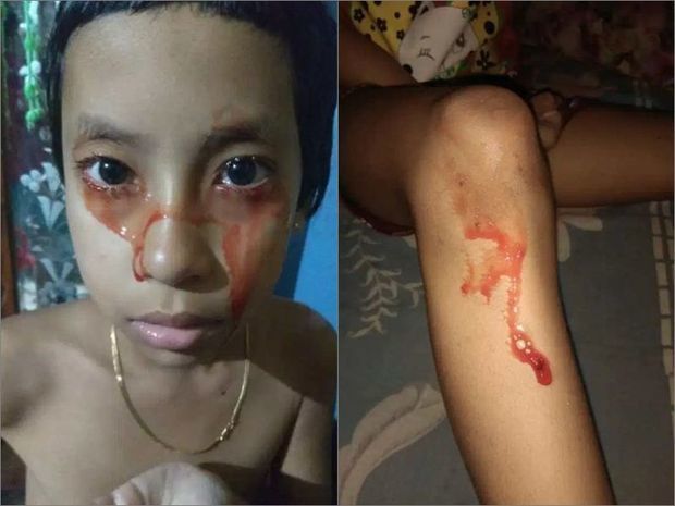 Восьмилетняя девочка начала потеть и плакать кровью - ВИДЕО