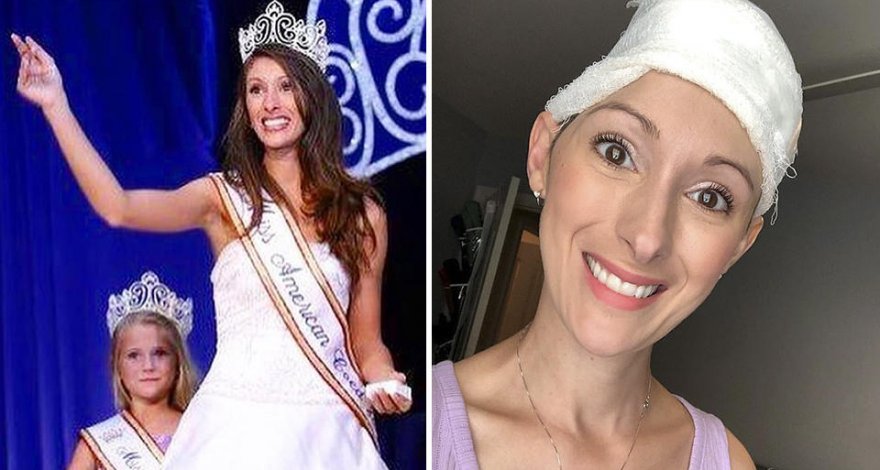 Бывшей королеве красоты после инсульта удалили часть черепа