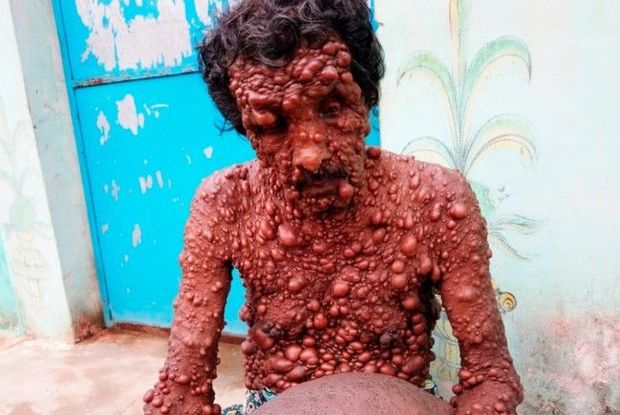 Hindistanda yaşayan kişinin bütün bədəni xoşxassəli şişlə örtülüb - FOTO