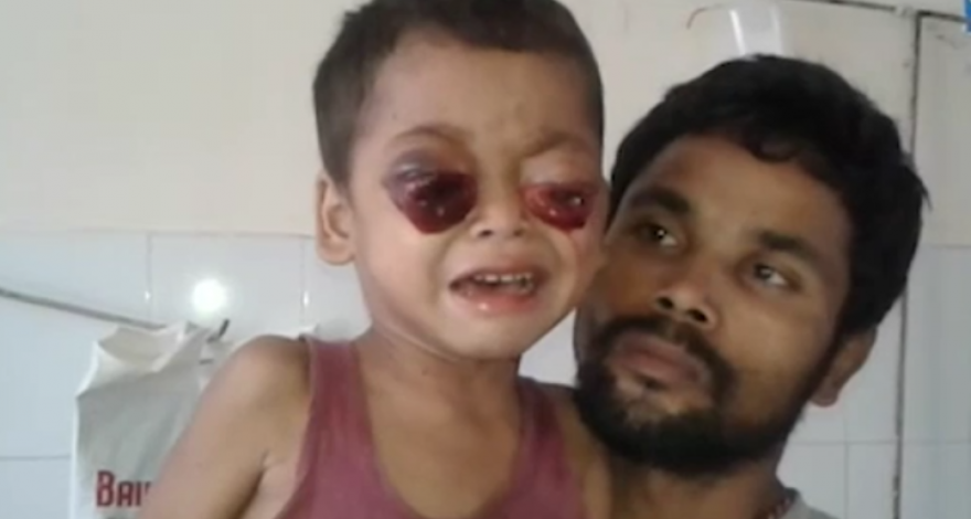 Медицинское чудо в Индии: Мальчику, чьи глаза из-за рака вылезли из орбит, вернули зрение – ФОТО