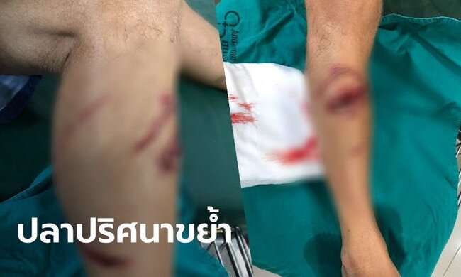 Bulanıq suda üzən turistin ayağını köpəkbalığı dişlədi - DƏHŞƏTLİ FOTO