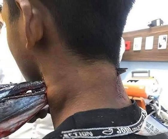 Sudan tullanan balıq oğlanın boynunu deşdi - FOTO