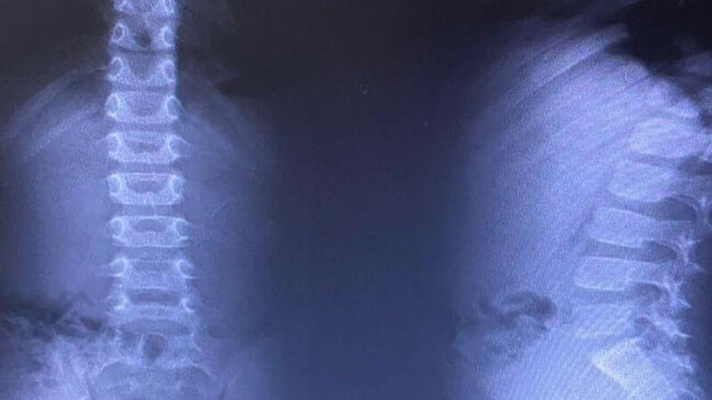 Bakıda 8 maqnit udan uşaq əməliyyat edildi - FOTO