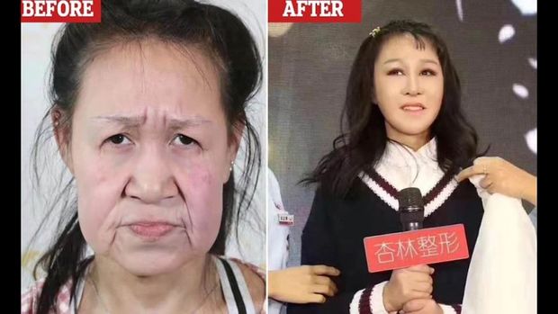 Qoca sifətli yeniyetmə əməliyyatdan sonra gözəlliyi ilə hamını təəcübləndirdi – FOTO/VİDEO