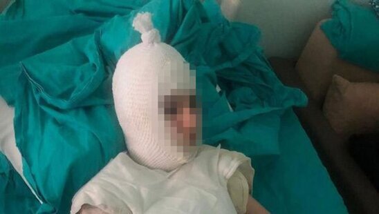 Ana tətilə gələn ögey qızının başına qaynar su tökdü - DƏHŞƏT