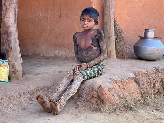 Ağır xəstəlik yeddi yaşlı qızı “daşa döndərir” – FOTO/VİDEO