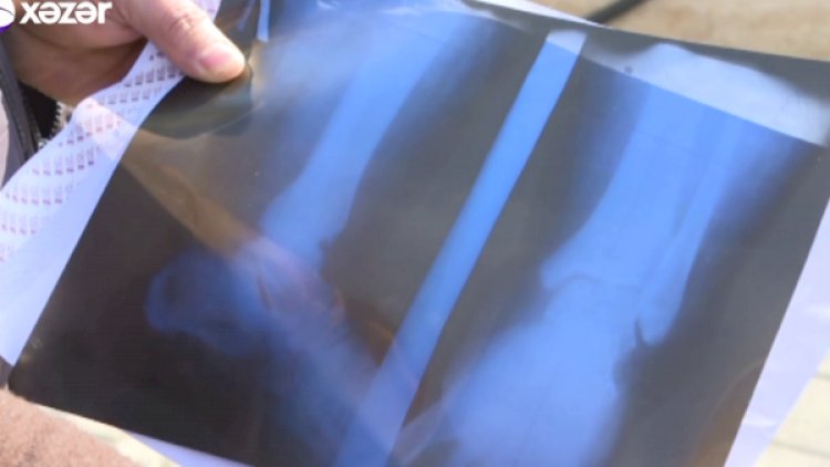 Azərbaycanda həkim sınıq olmayan ayağa gips qoydu - ŞOK İDDİA - VİDEO