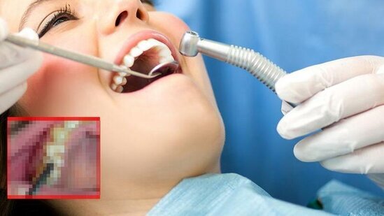 Diş həkiminə müraciət edən qadının ağız boşluğundan çıxanlar şoka saldı - FOTO