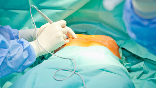 Həkimlər qadının iki əlavə döşünü kəsdilər