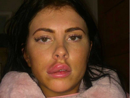 Şişirdilmiş dodağının partlaması qadını kor edəcəkdi - FOTO