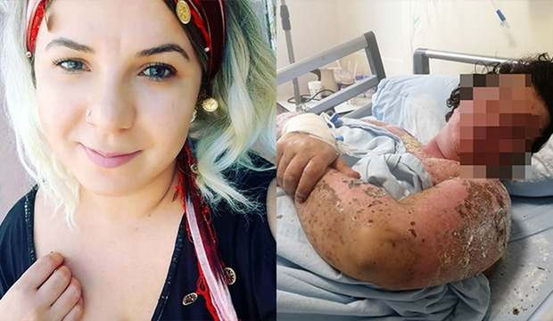 Gənc qadın antibiotiklərə görə tanınmaz hala düşdü - VİDEO