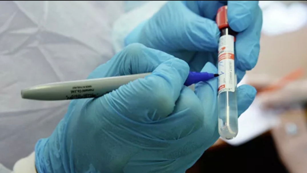 Rusiyada gün ərzində koronavirusa yoluxanların sayı 53 nəfər olub