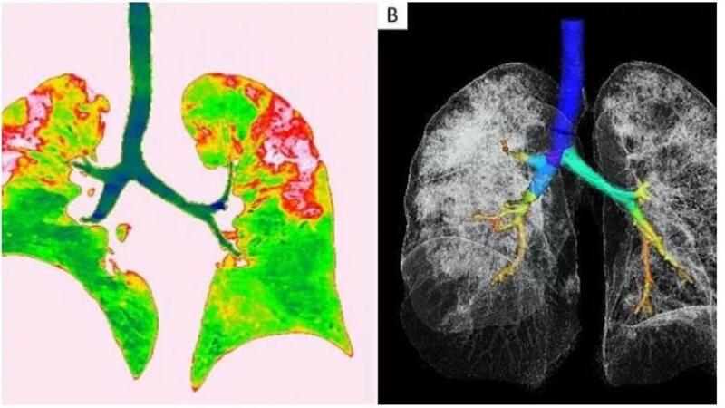 Koronavirusdan sağalanların ağciyərlərində elə şeylər tapıldı ki... - Dəhşətə gələcəksiniz