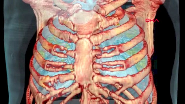 Koronavirusa yoluxanların ağciyərləri bu hala düşür - Video