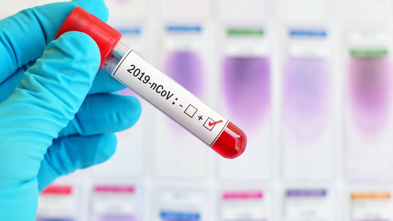 Azərbaycanda daha 27 nəfərdə koronavirus aşkarlandı