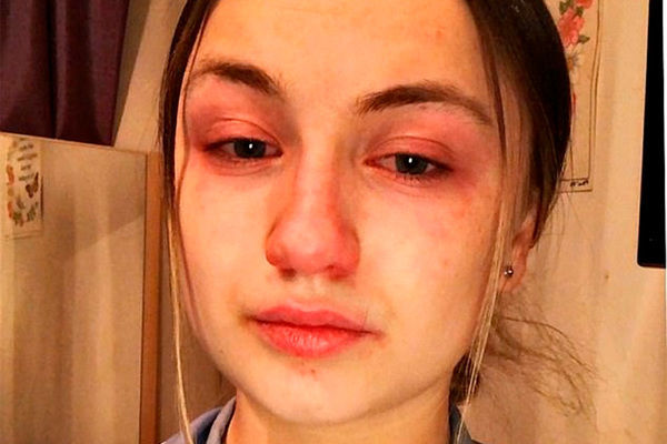 Tibb bacısı koronaviruslu xəstələrin əzabından danışdı