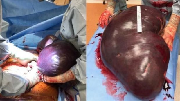 В США хирурги вырезали крупнейшую в истории медицины селезенку