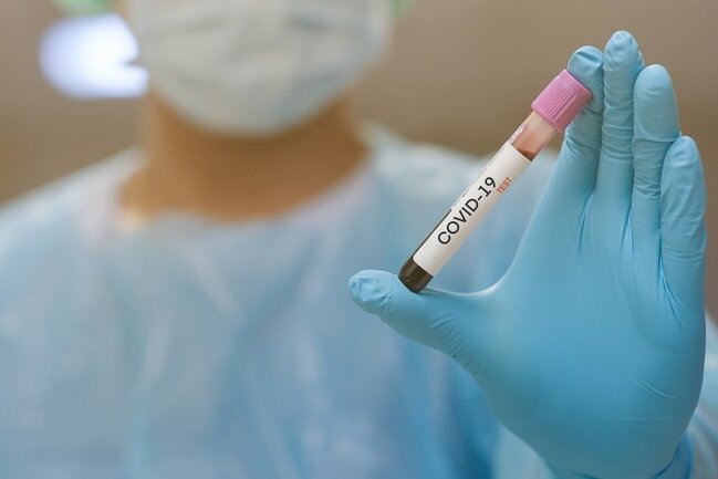 Azərbaycanda daha 77 nəfər koronavirusa yoluxdu, 15 nəfər sağaldı