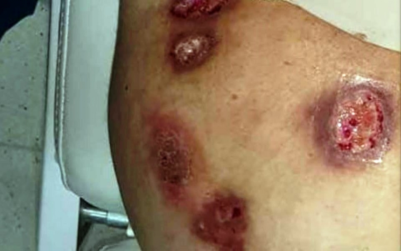 Bakıda “popo böyütmə” əməliyyatı etdirən qadının bədəni bu hala düşüb – Yara cərrahından AÇIQLAMA - VİDEO